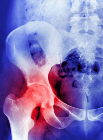 The image is of a pelvis X-ray with the joint on the left highlighted in red. 